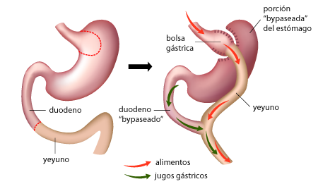bypass_gastrico1